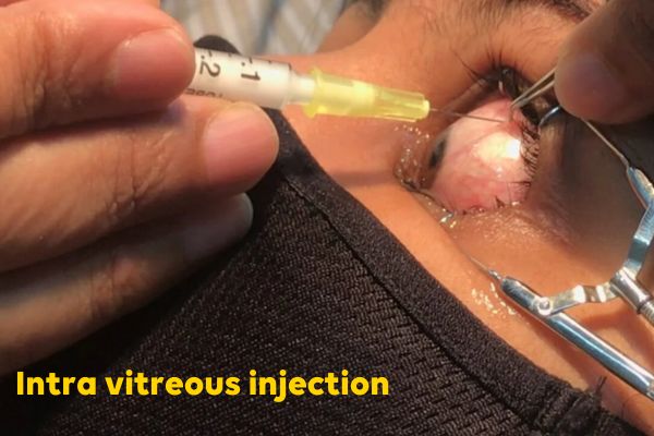 Intra vitreous injection